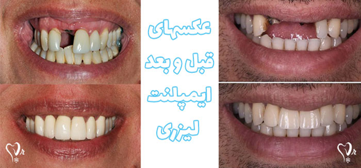 ایمپلنت فوری با لیزر